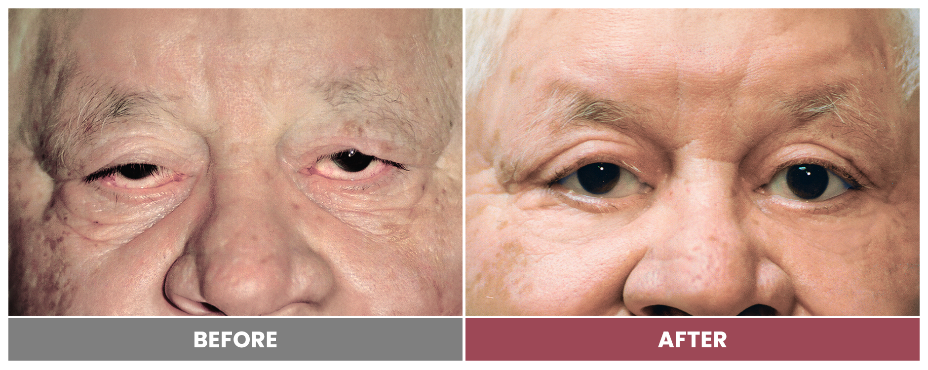 BLEPHAROPLASTY & PTOSIS REPAIR - Case 3